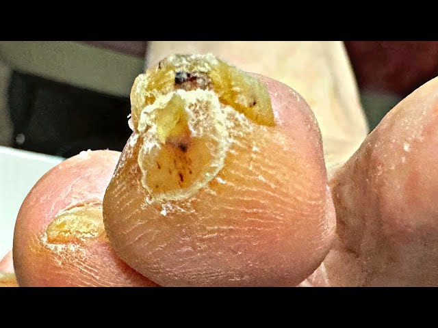 DEEP Corn Removal On Tip Of The Toe!