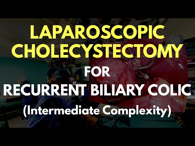 (FULL CASE) Laparoscopic Cholecystectomy for Recurrent Biliary Colic