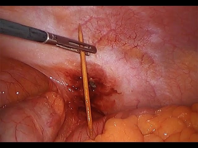 Laparoscopic removal of a toothpick from the large intestine