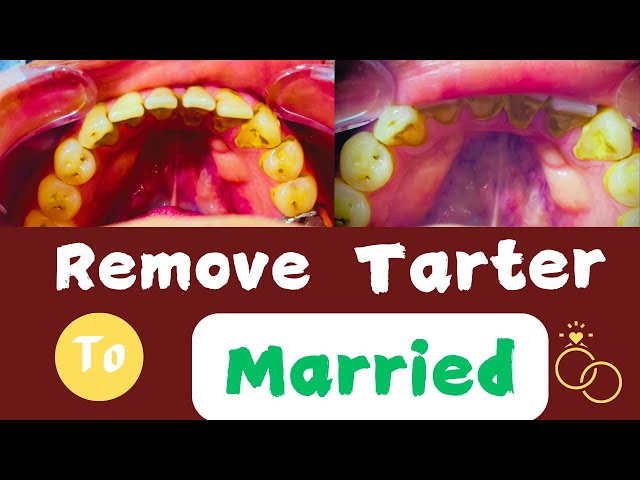 Tartar REMOVED: The WORST Thing You're Doing to Your Teeth!