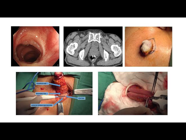 22-428 Loop ileostomy closure