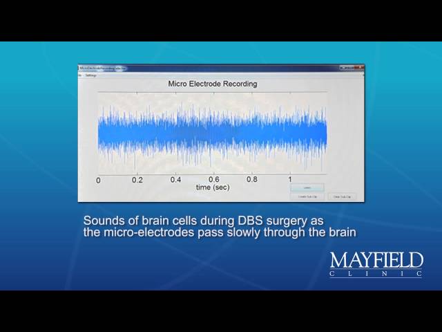 Sounds of brain cells during DBS surgery