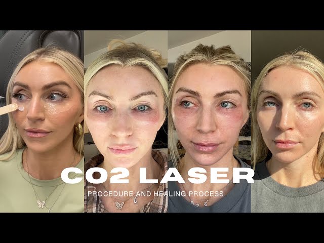 I GOT A CO2 LASER FOR MY UNDER EYE WRINKLES + LOOSE SKIN | is it worth it? daily check ins