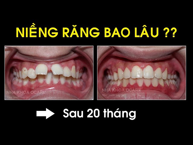 Niềng răng bao lâu thì đẹp?