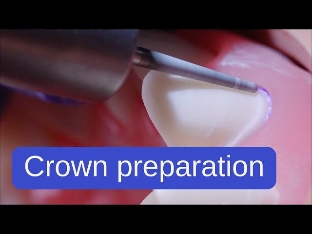 Two-plane preparation for a crown without undercuts