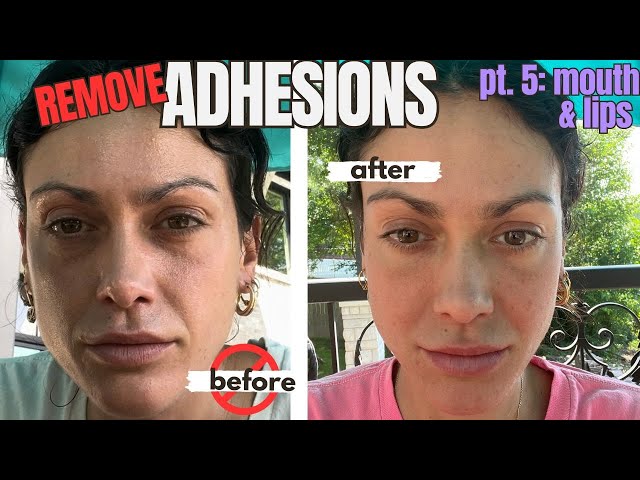 ADHESIONS: The glue your body makes that could be destroying your face Pt. 5 Mouth & Lips