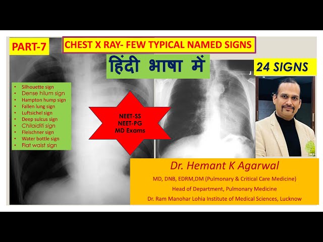 Chest X Ray-7 Typical Named Sign (हिंदी में)/ Pulmonary Radiology #NEET-SS Pulmonary Med. @Hemant