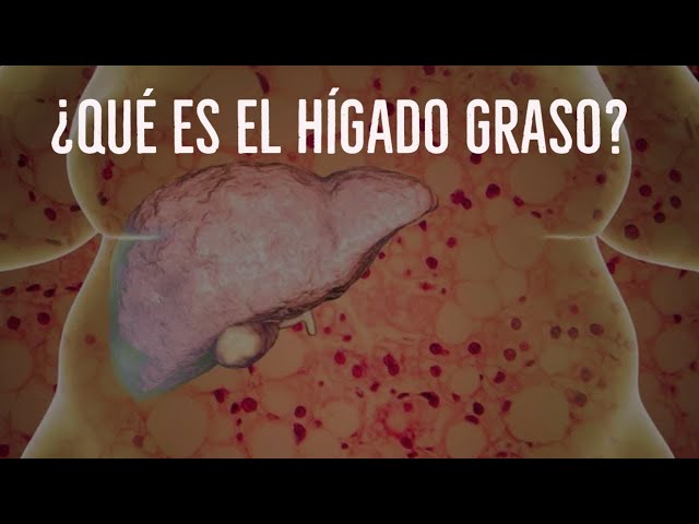 What is the fatty liver? (nonalcoholic hepatic steatosis)