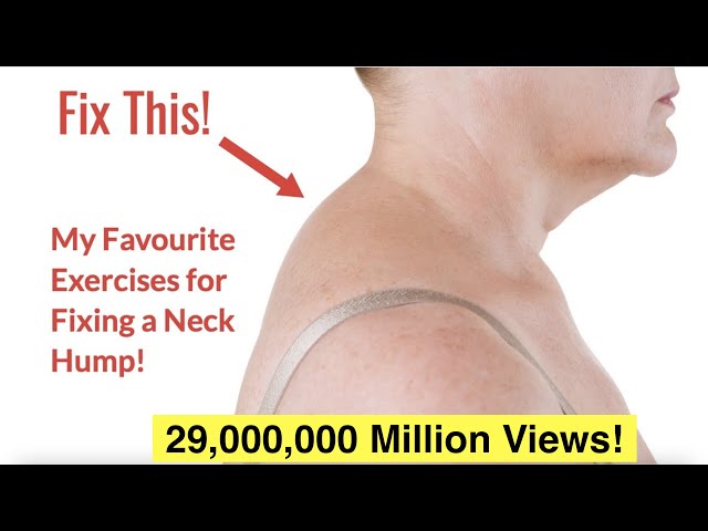 How to Fix a Neck Hump at Home (FAST) | With FREE Exercise Sheet!