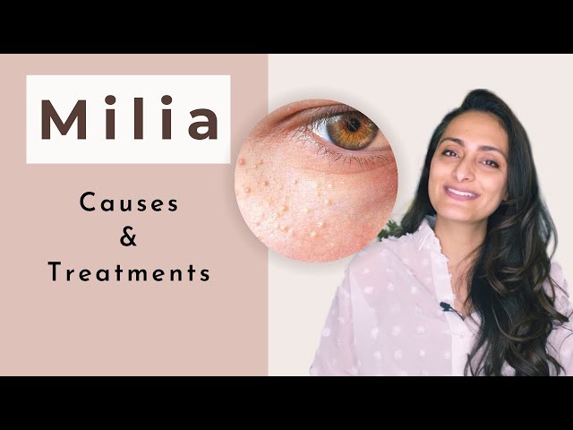 Milia | What is milia | Causes| Treatment | dermatologist | Dr. Aanchal Panth