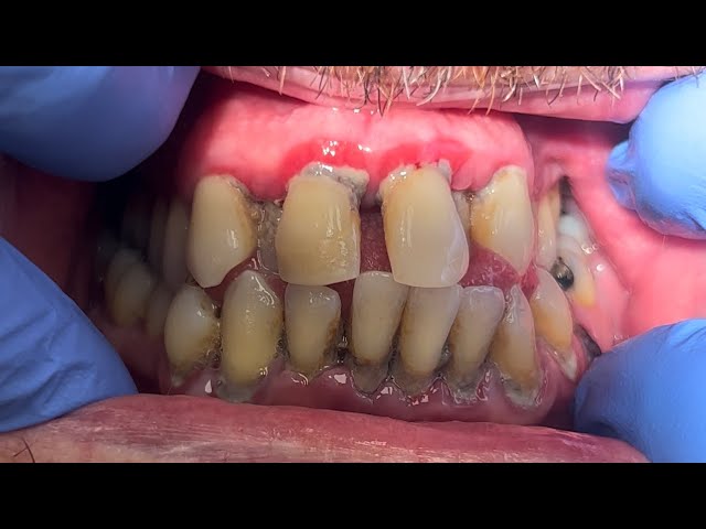 COMPILATION VIDEO OF  DENTAL CLEANING,Flossing Brushing