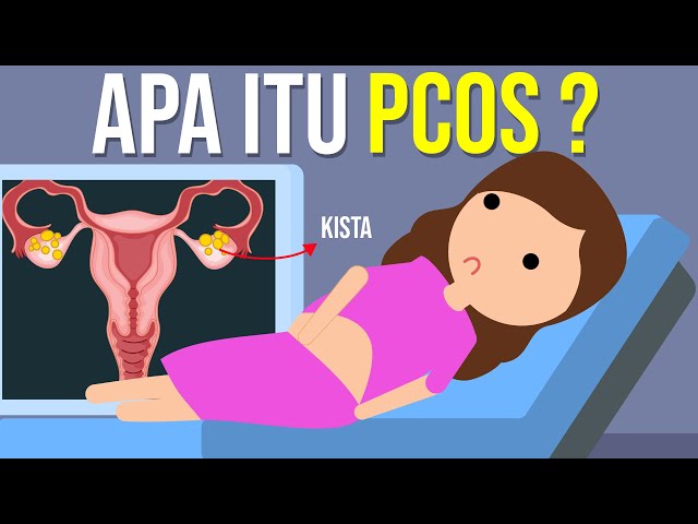 PCOS? Apakah Masih Bisa Hamil?