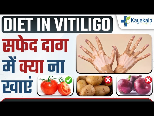 सफेद दाग में क्या नहीं खाना चाहिए? | Food to Avoid in Vitiligo | Diet In Vitiligo | Kayakalp Global