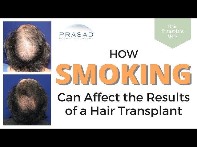 Smoking Can Affect Healing and Survival of Hair Grafts after a Hair Transplant