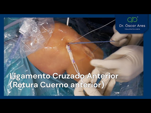 Ligamento cruzado anterior y Rotura Cuerno anterior