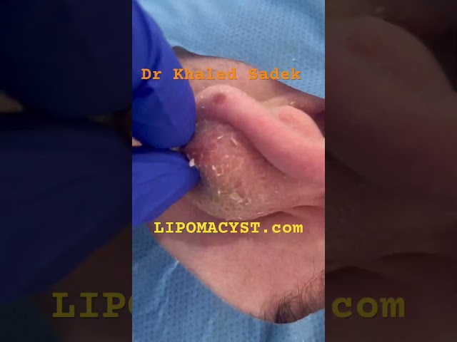 Biggest ear cyst Ever! #skincare #blackheadremoval Dr Khaled