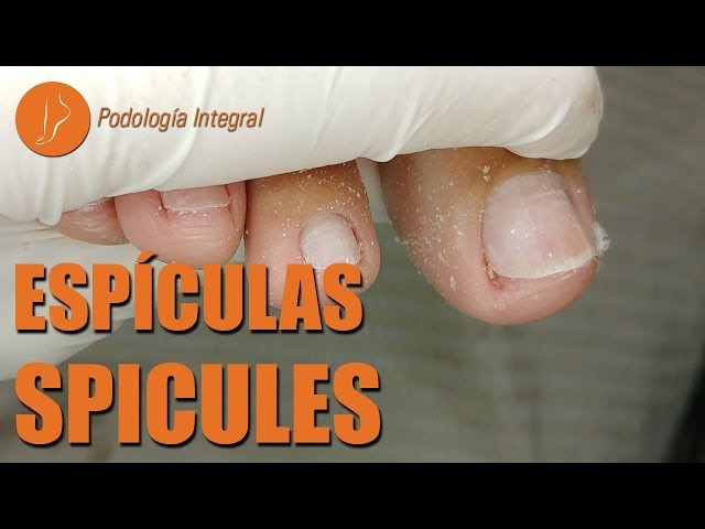 Spicules on big toes [Podología Integral] #podologiaintegral