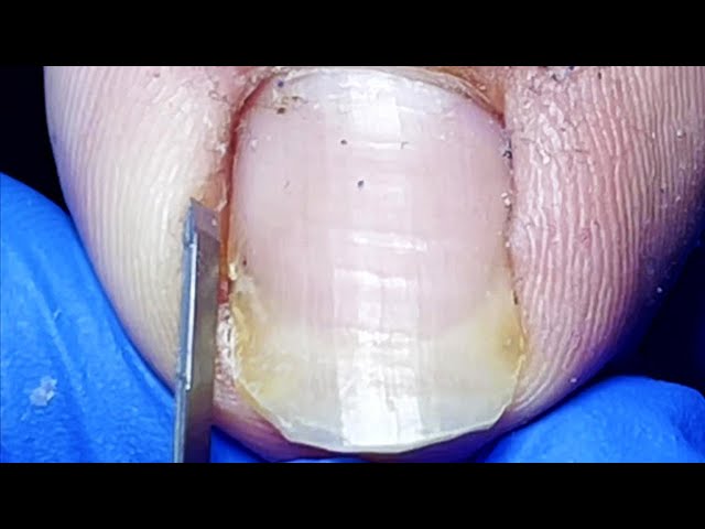 Toenails that haven’t been cut in 2 months, easily trim ingrown toenails