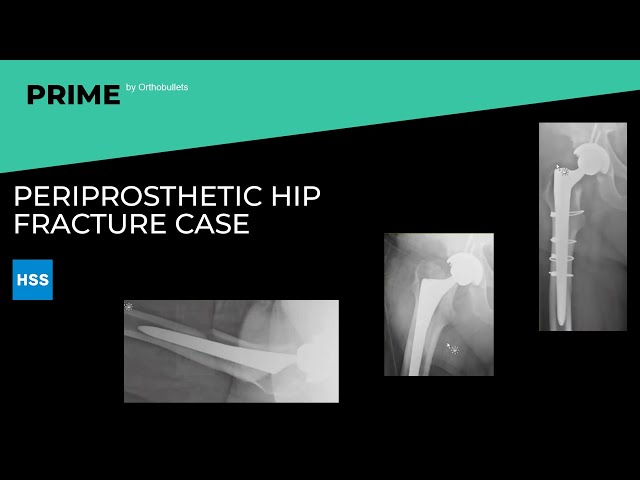 Periprosthetic Hip Fracture Case - Steven J. MacDonald, MD, FRCSC