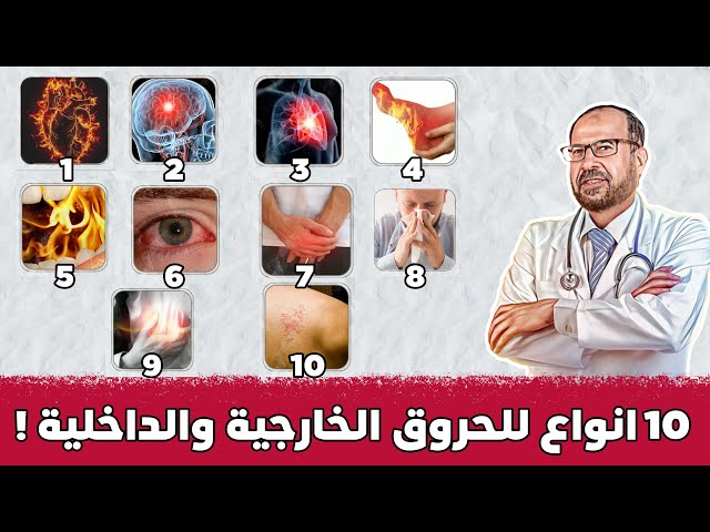 علاج الحروق الداخليه  !