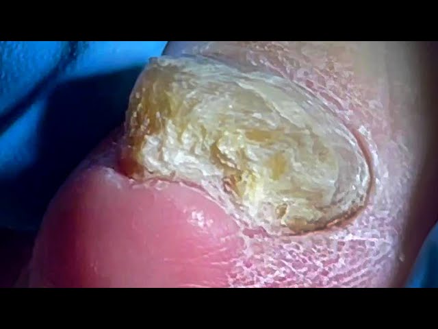 Super thick rare onychomycosis, scraping off the broken part layer by layer【Pedicure Master Lin Jun】