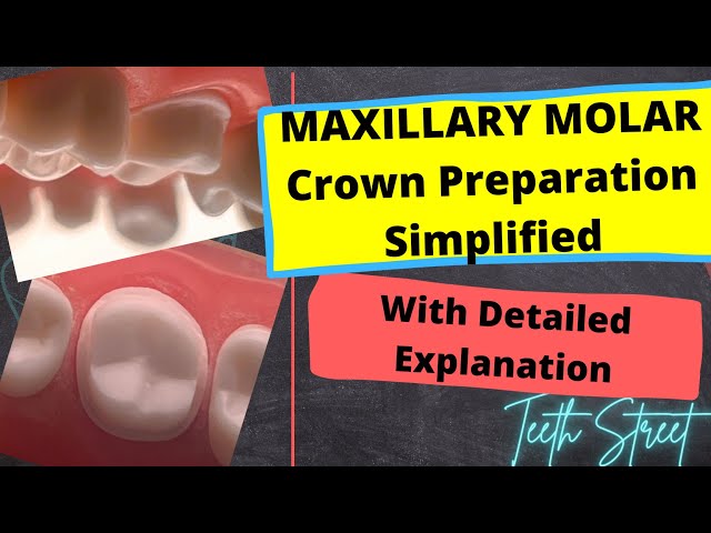 Maxillary Molar Crown Preparation Technique Made EASY! (Metal Crown)