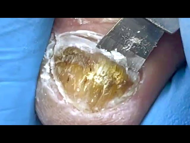 Scraped soft nails, fungus infected nails that turn into skin【Pedicure Master Lin Jun】