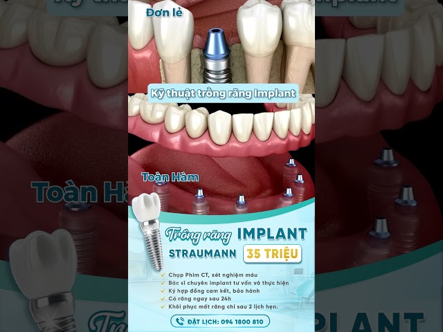 IMPLANT STRAUMANN THUỴ SĨ