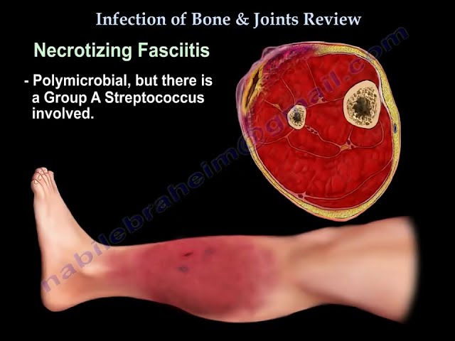 Bone and Joint Infections: Causes, Symptoms, and Treatment Options