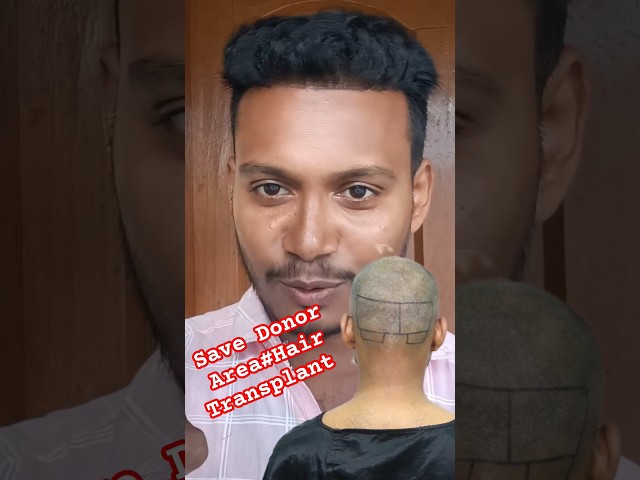 Save Donar Area In hair transplant#hairtransplantkolkata #prp #monotosh