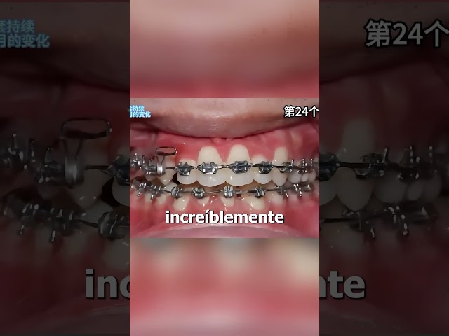 Transformación DENTAL😱🦷