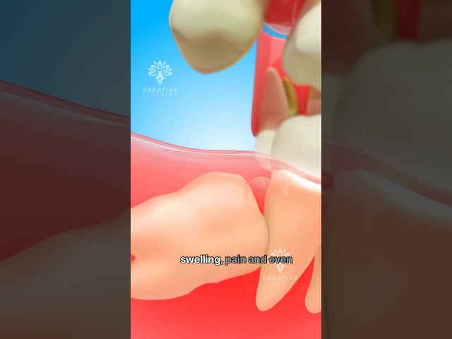 Impacted Wisdom Tooth Removal – What Really Happens 🦷 #short  Creativelearning3d