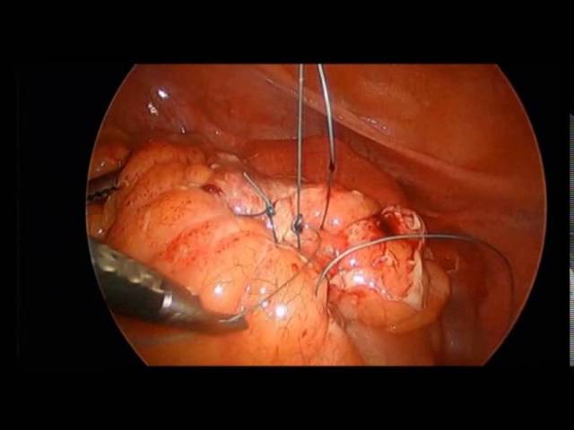 Laparoscopic primary repair of perforated diverticulitis by Dr. Iraniha