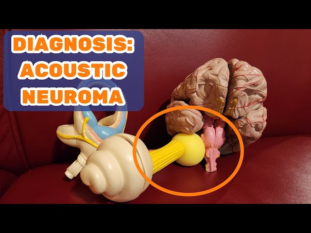 DIAGNOSIS: Acoustic Neuroma, a Vestibular Brain Tumor - Dizzy Therapy