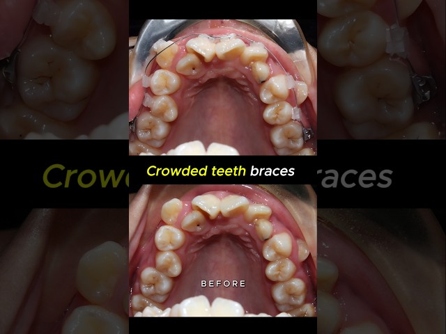 Crowded teeth braces transformation. 36 months time #orthodontist #braces #dentist