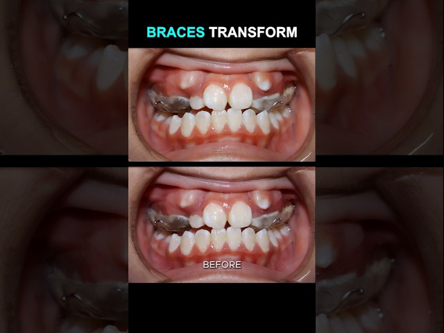 How to move teeth when braces #braces #orthodontist #dentist