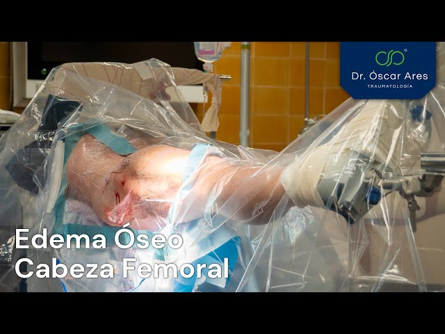 Edema óseo cabeza femoral - Dr. Oscar Ares