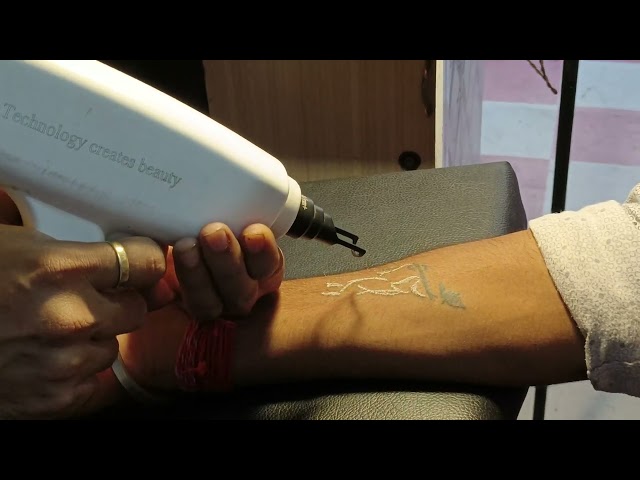 #army  #bharti #mate #tattoo #remove #tattooremoval #viral #trending #viral #removetattoo