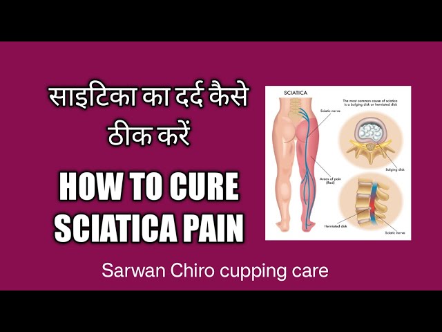 Sciatica pain chiropractic & Wet Cupping therapy