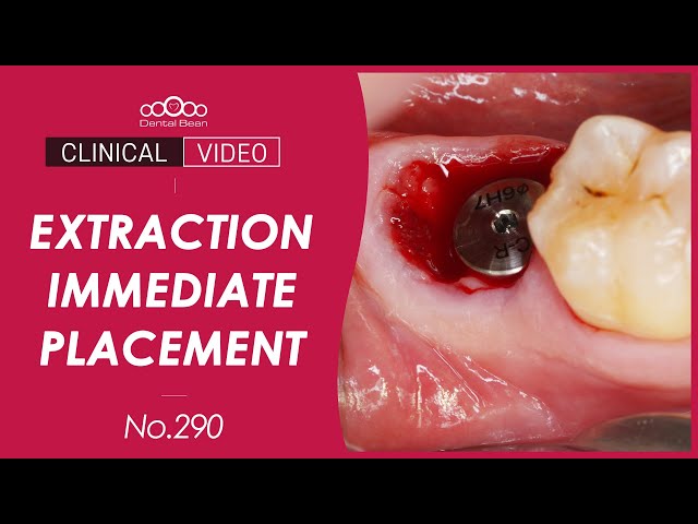 #47 Immediate Implant Placement [Dr. Cho Yongseok]