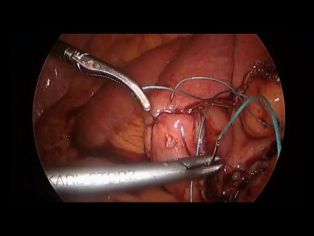 Laparoscopic small bowel resection with intracorporeal anastomosis for small bowel obstruction