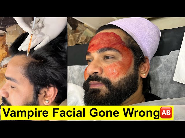 Vampire Facial And Hair Prp || Aisa Facial Pehli Bar Dekha