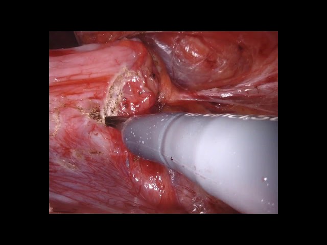 Robotic assisted right scrotal hernia repair with mesh