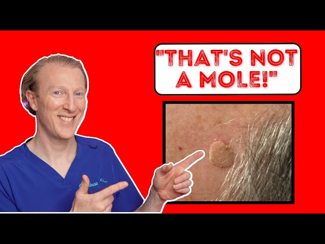 That's not a mole! Uncovering the Mystery of Seborrheic Keratosis