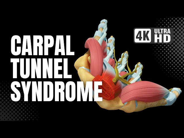 Carpal Tunnel Syndrome Surgery - 4K 3D Animation