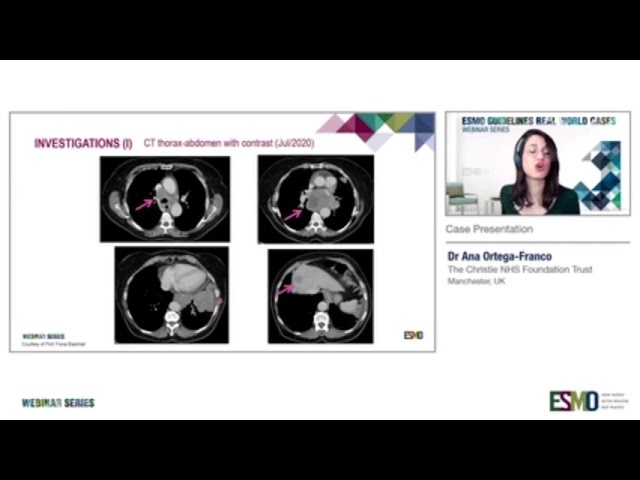 ESMO Guidelines: Real World Cases - Small Cell Lung Cancer。ESMO 指南：真实案例 - 小细胞肺癌