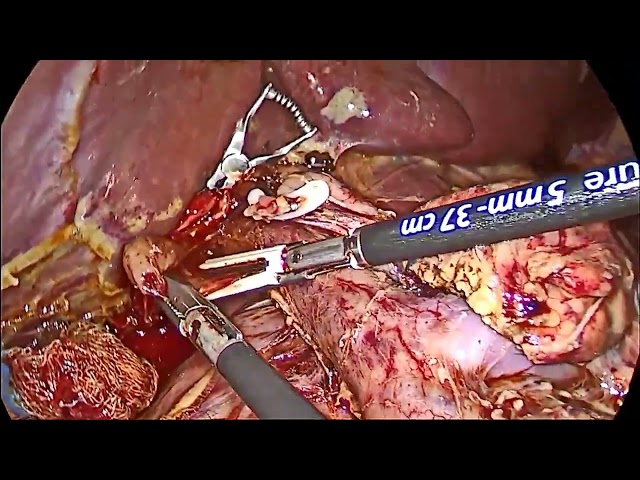 Totally Laparoscopic Pancreaticoduodenectomy (Whipple's Procedure) / Ahmet Türkoğlu