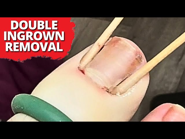 Double Ingrown Nail Removal On a 12-Year-Old Patient!