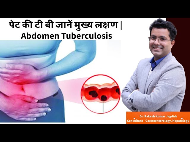 पेट की टी बी जानें मुख्य लक्षण || Abdomen Tuberculosis | Dr Rakesh Kumar #tuberculosis