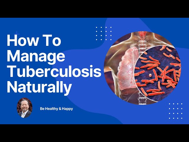 How To Manage Tuberculosis Naturally: Holistic Solutions for Recovery